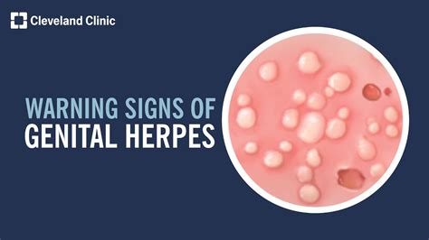 simptome herpes genital|Genital Herpes Symptoms: What to Look For